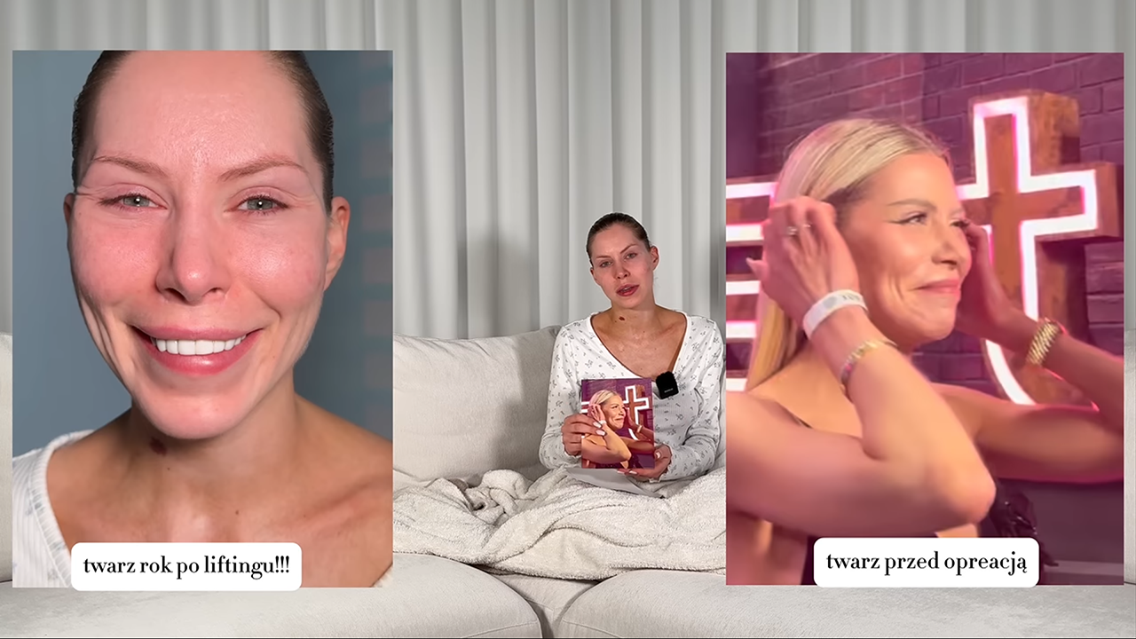 Julia von Stein żałuje liftingu. Czy internetowy kult „wiecznej młodości” poszedł o krok za daleko?